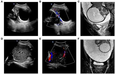 Parallel Loop Binding Compression Suture, a Modified Procedure for Pernicious Placenta Previa Complicated With Placenta Increta